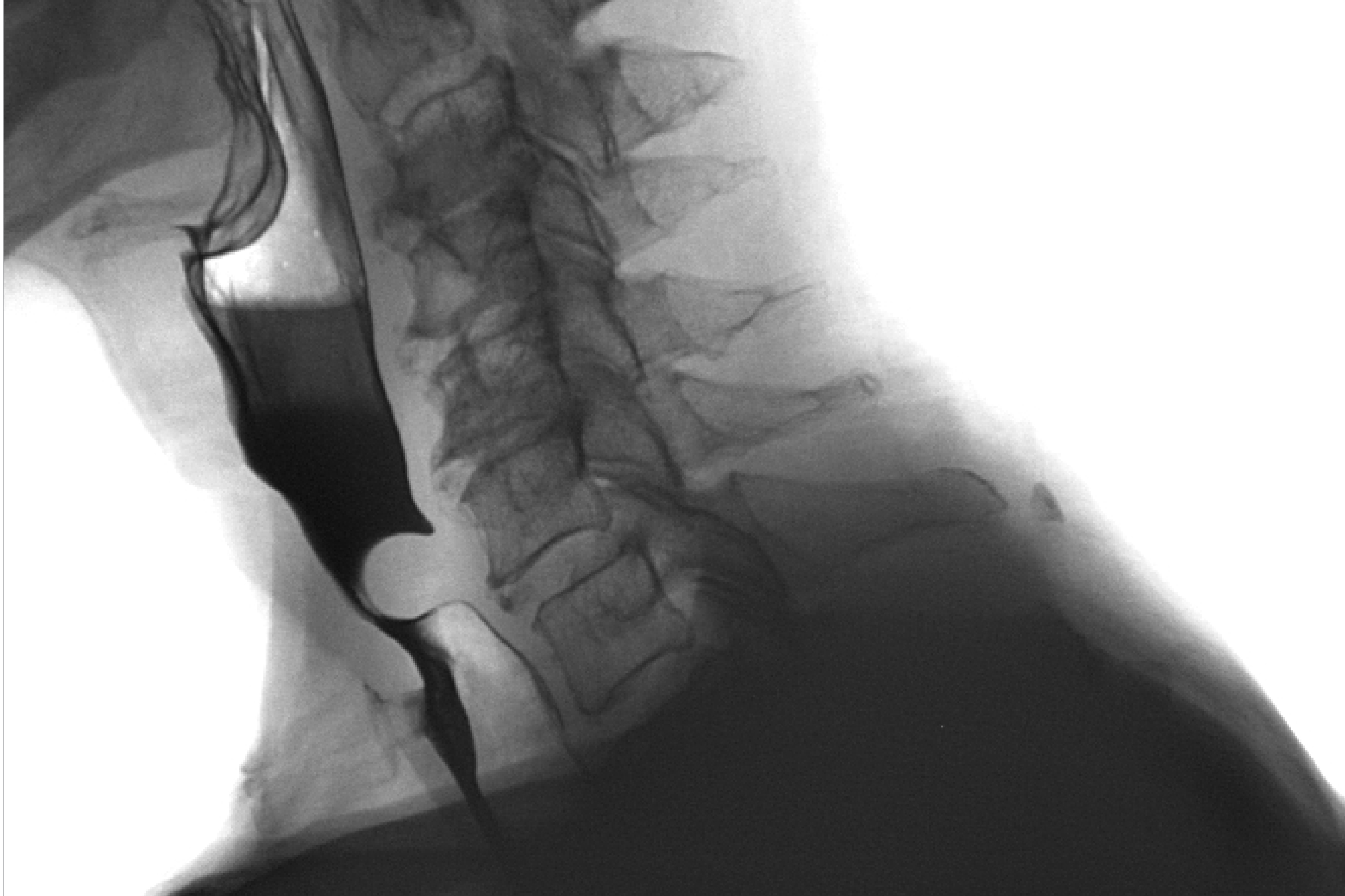PharyDoc dysphagia examination